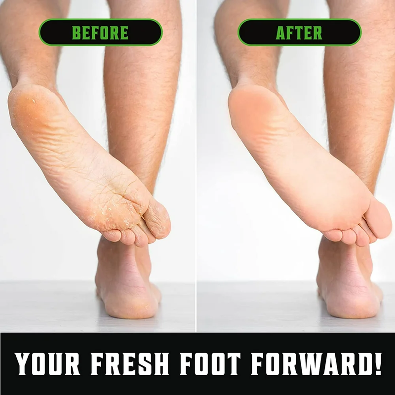 Tea Tree Oil Body Wash - Anti-fungal Athlete's Foot Toenail Fungus & More