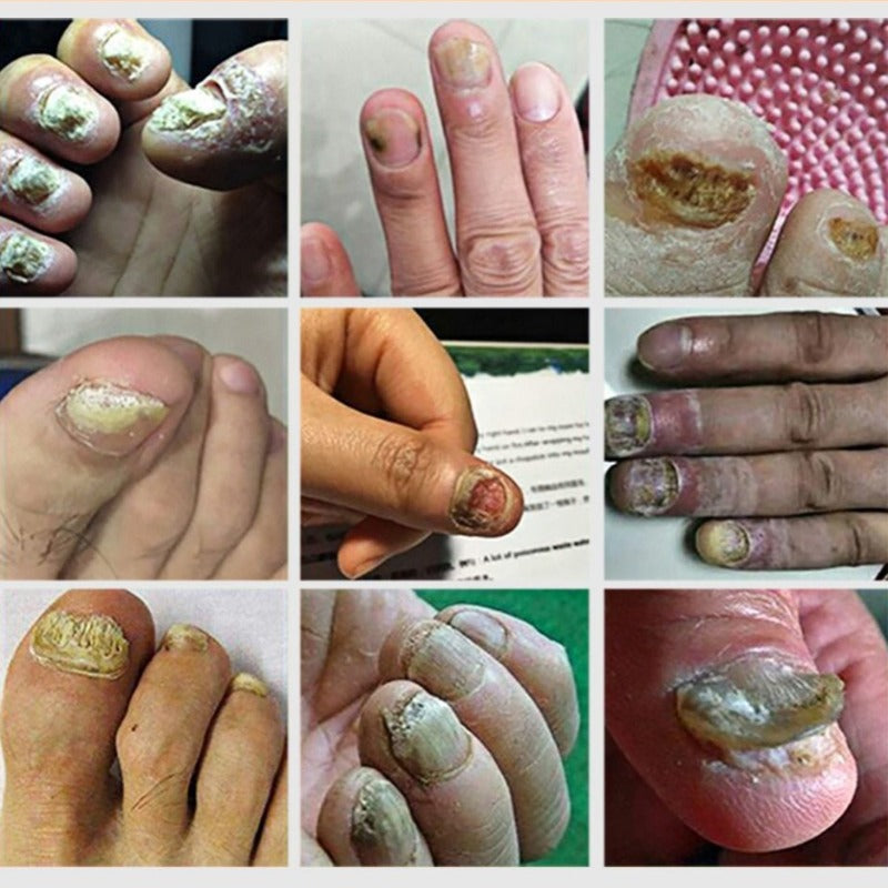 Nail Fungal Treatment Serum